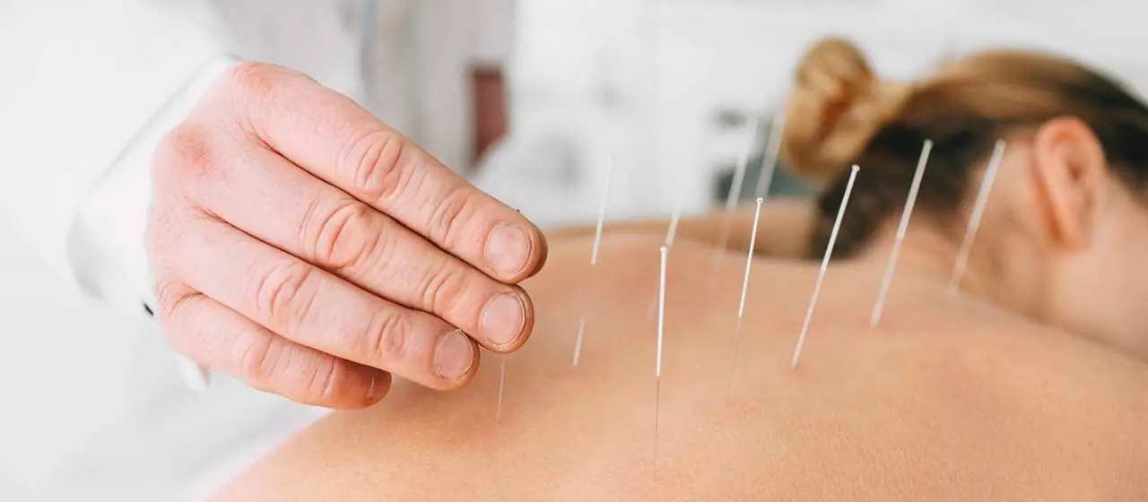 Acupuntura